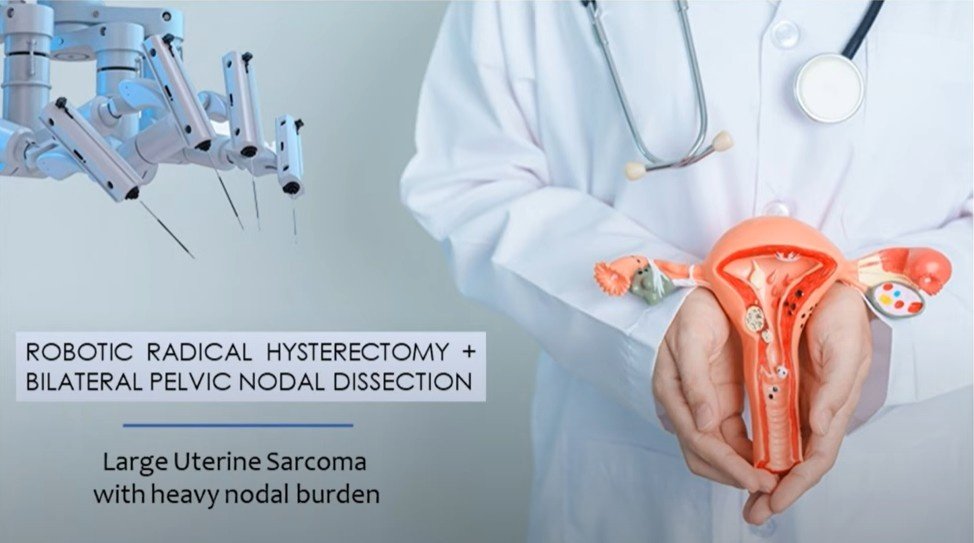 Large uterine sarcoma with heavy pelvic nodal burden