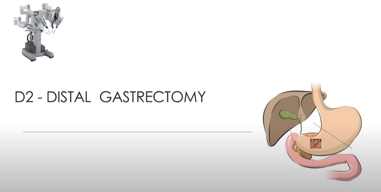 Ca Distal Stomach