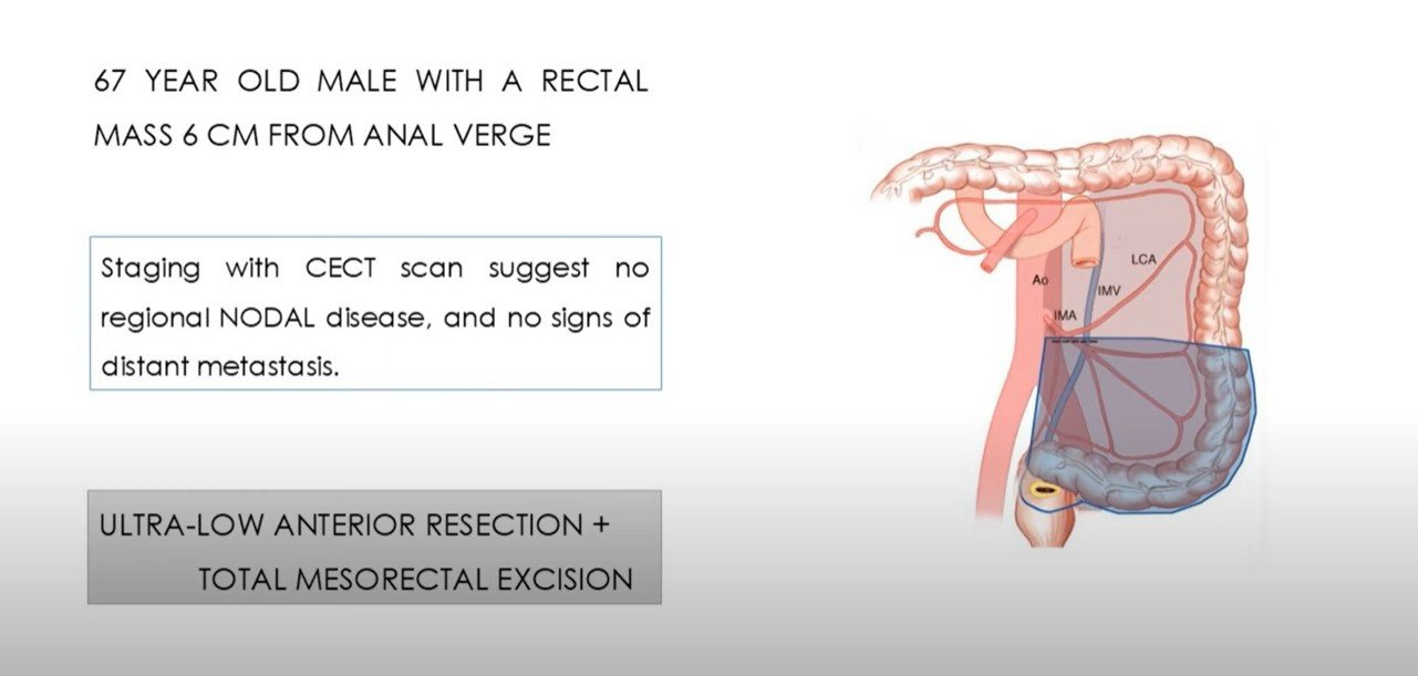 Ca Rectum