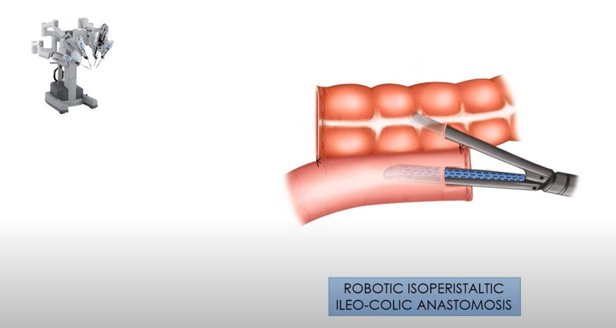 Right Hemicolectomy