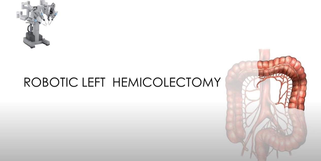 Ca Left Colon