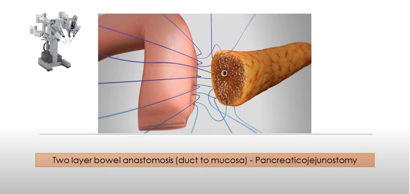 Robotic Pancreaticojejunostomy