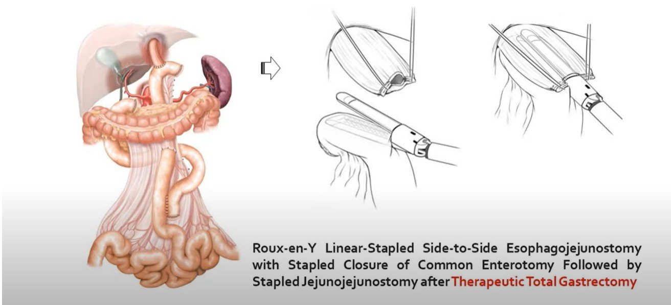 Ca Proximal Stomach
